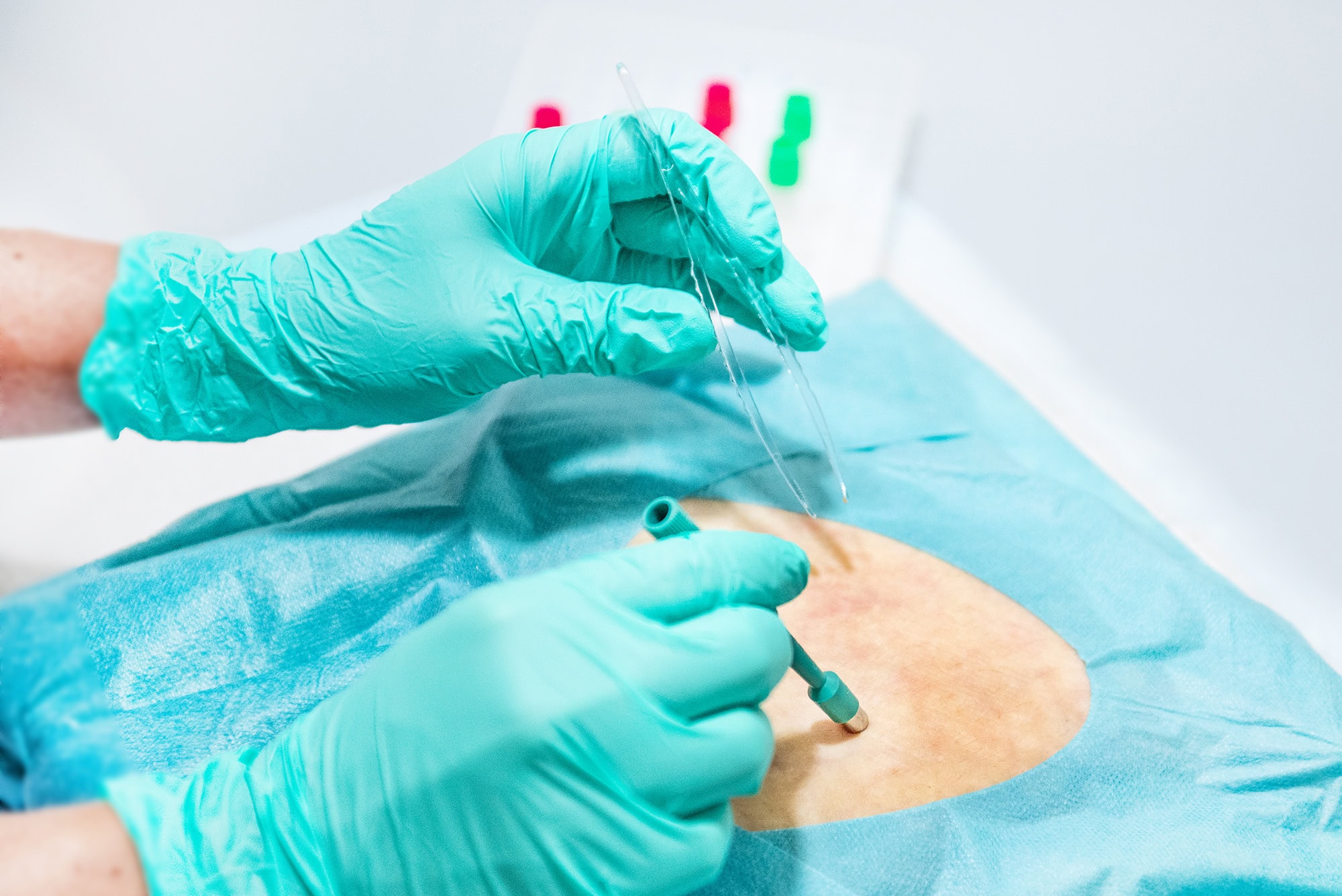 Entnahme einer Hautstanzbiopsie